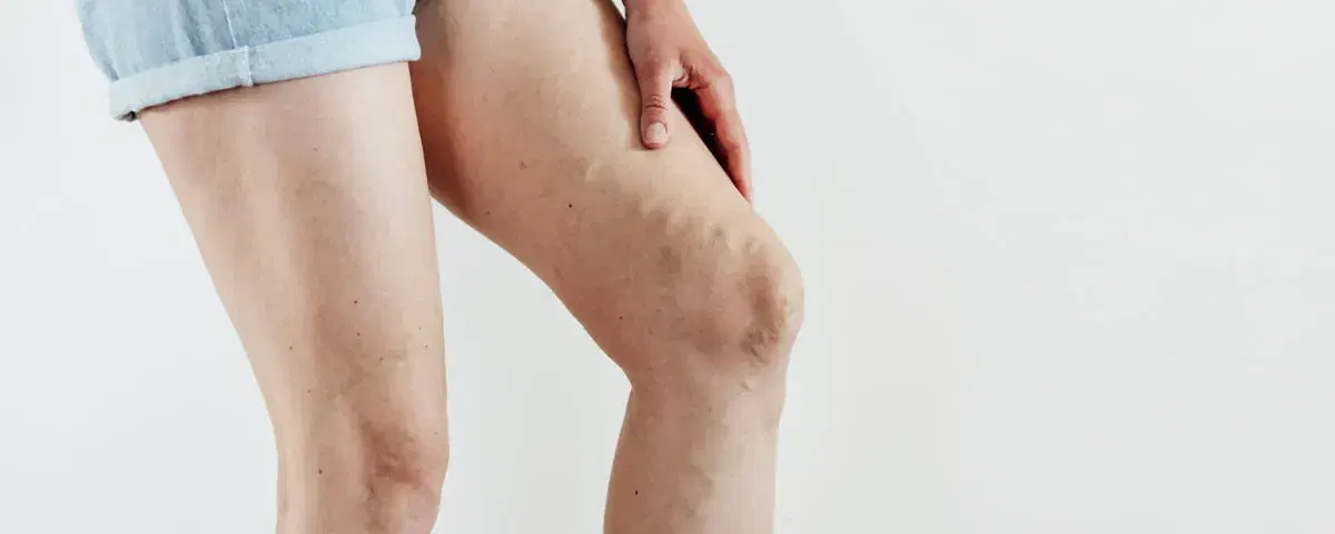 Tromboflebite
