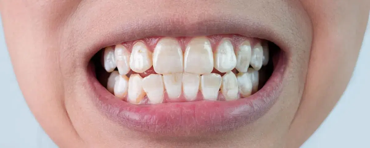 Fluorosi