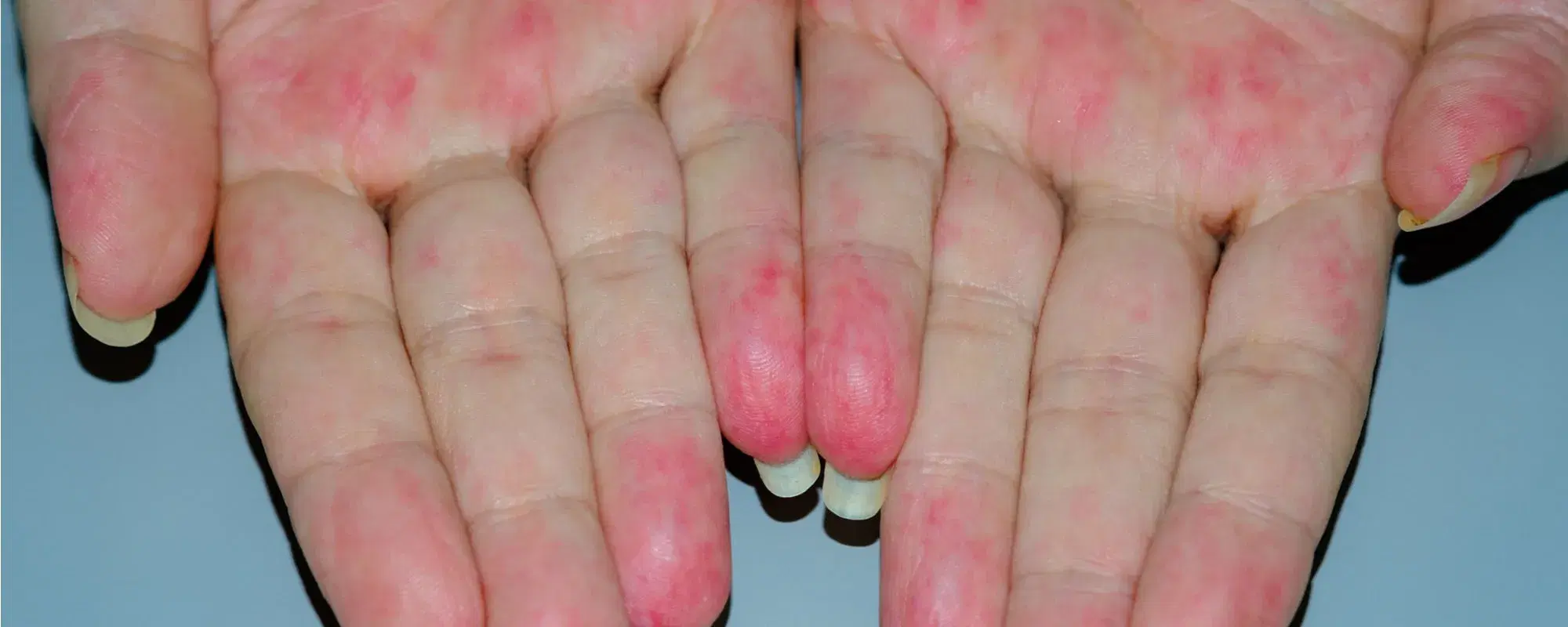 Vasculite