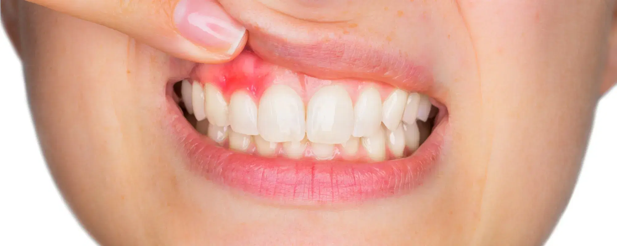 Ascesso dentale