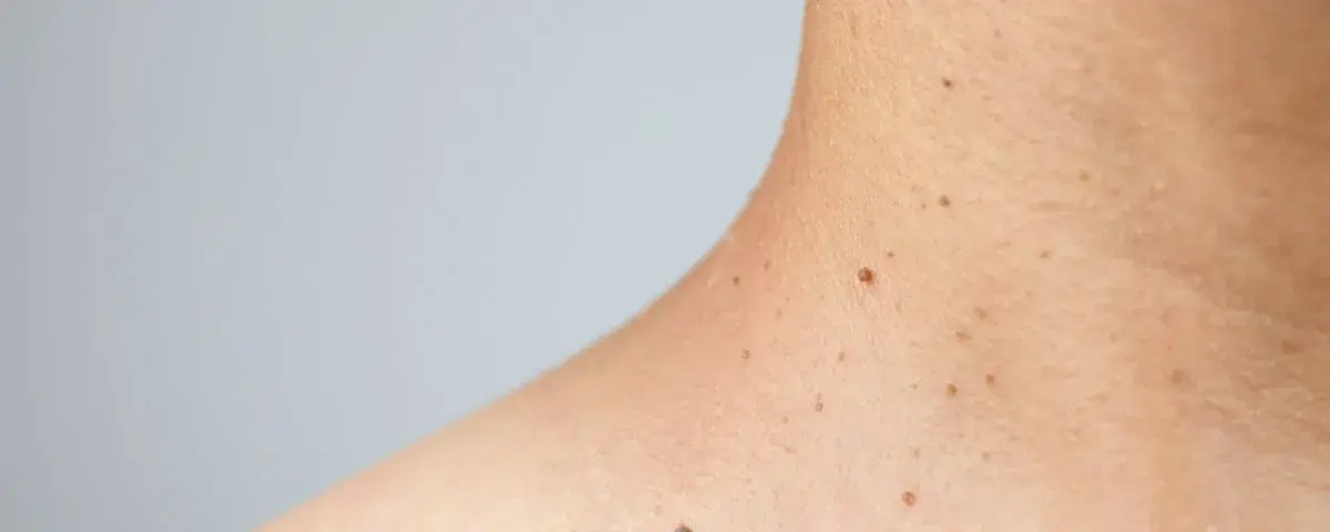 Fibromi penduli