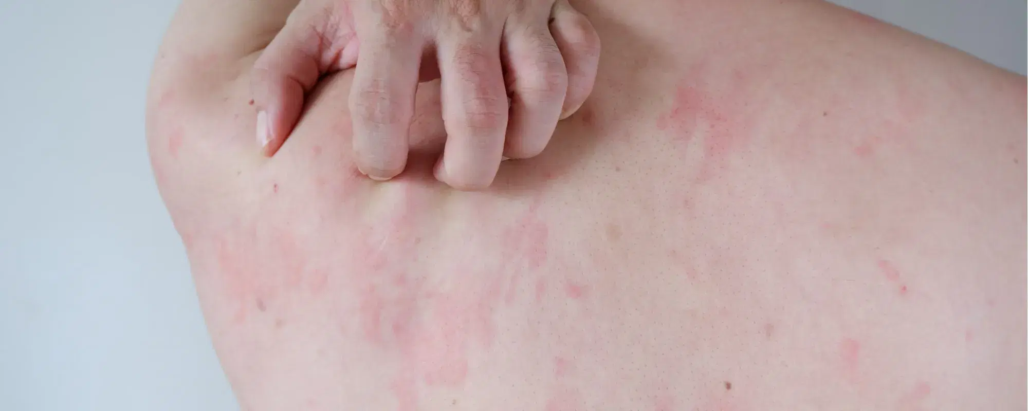 Orticaria