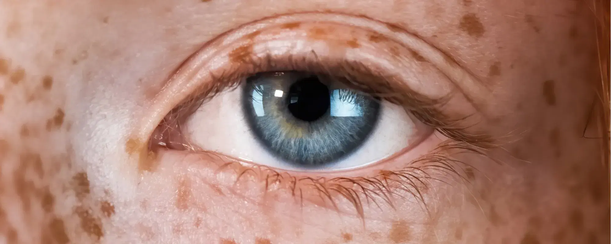 Xeroderma pigmentoso