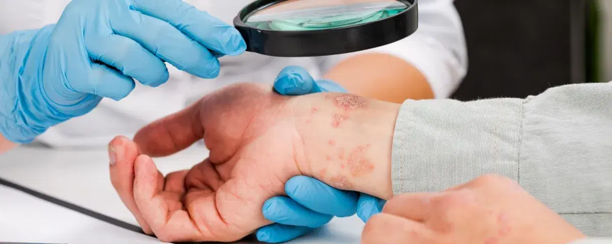 Verità e falsi miti: la psoriasi peggiora in estate o il sole fa bene?