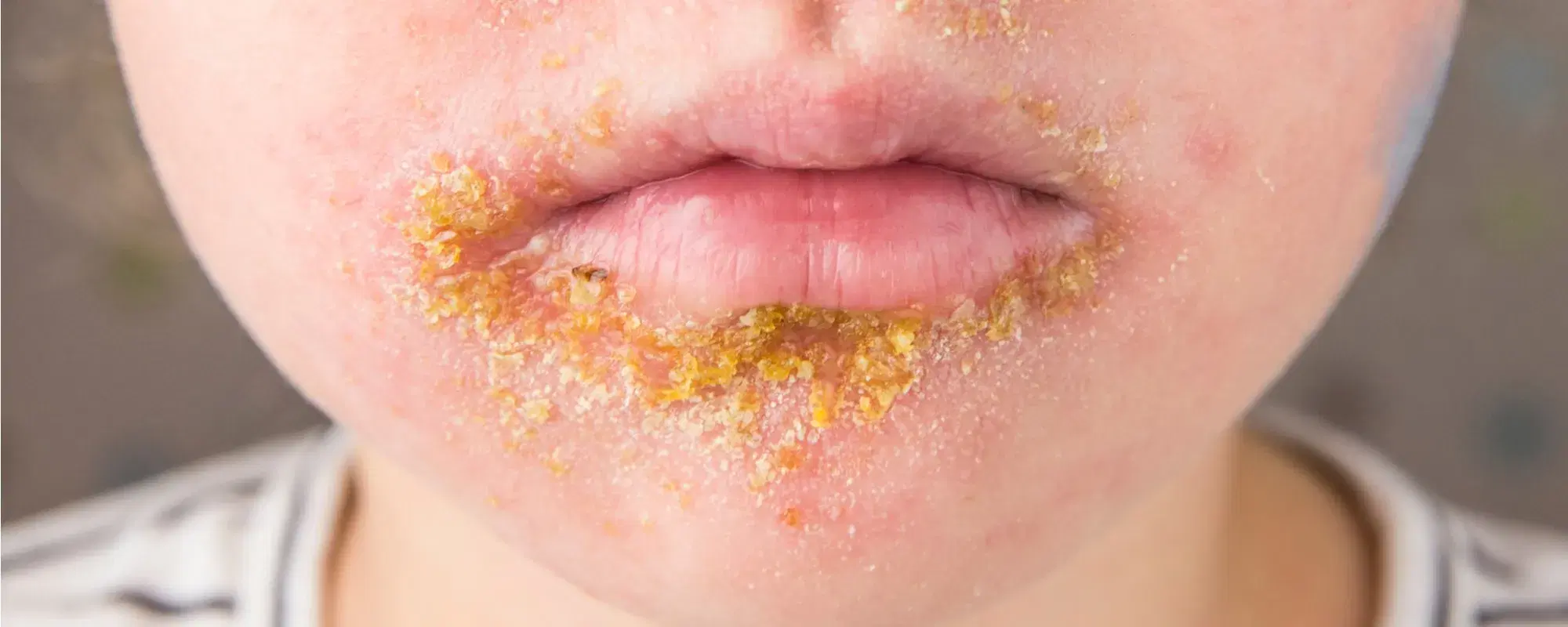 Impetigine
